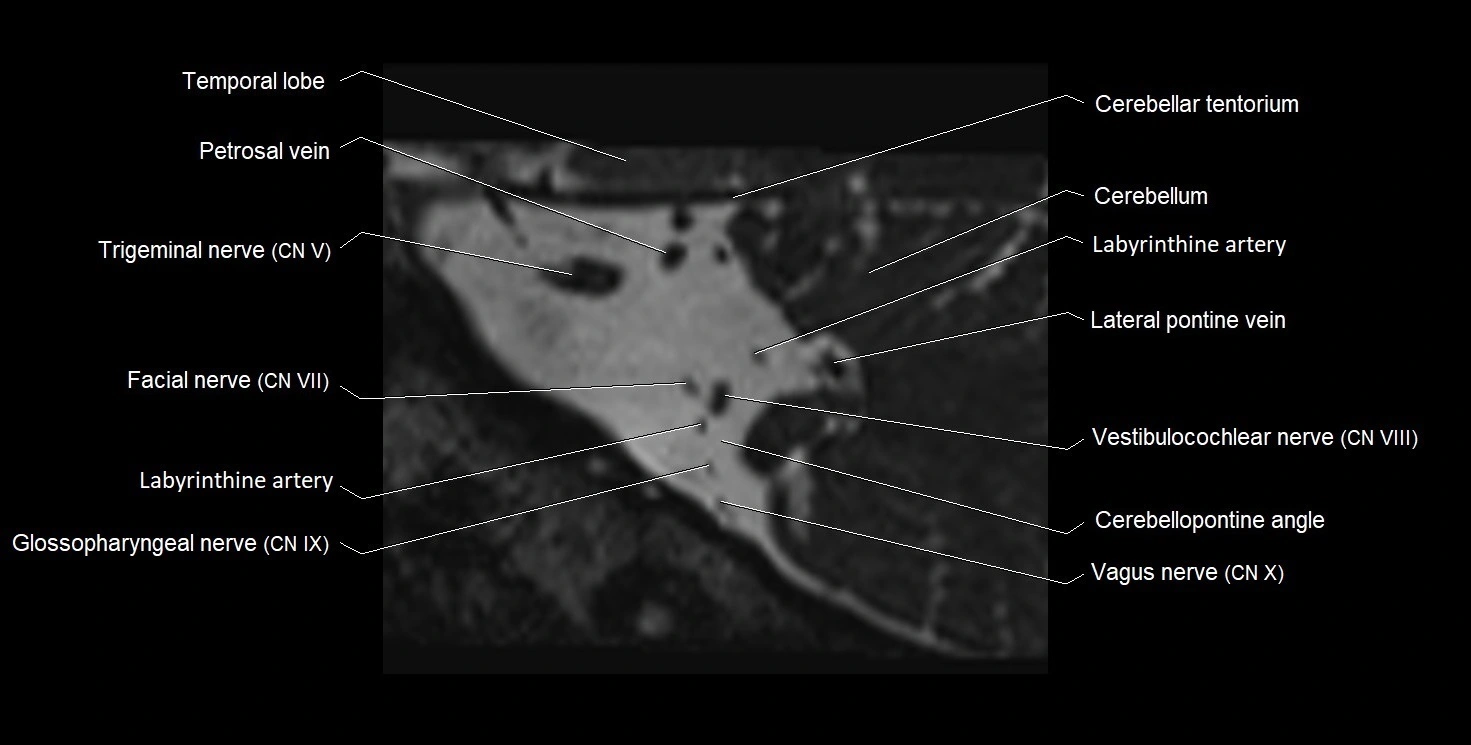 Internal auditory meatus (IAM) 3T sagittal cross sectional anatomy image 35.webp